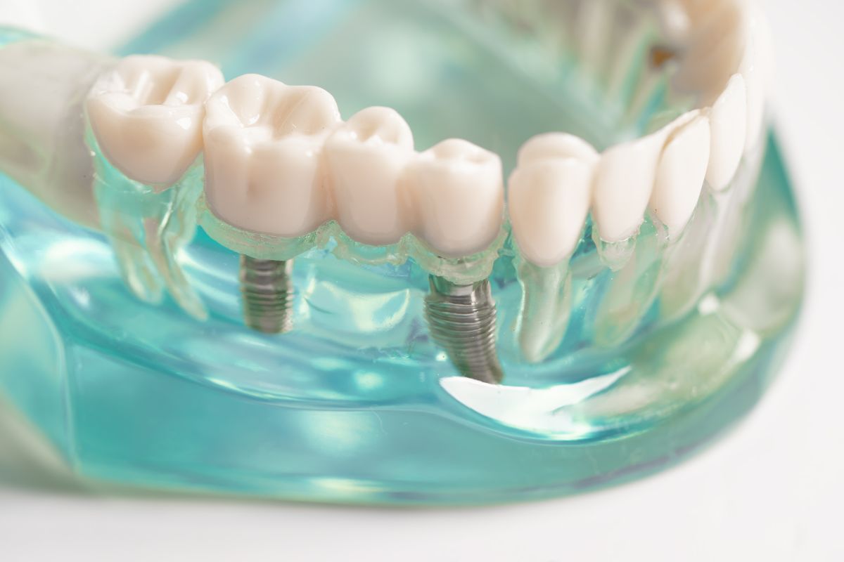 all-on-4 implants in florham park